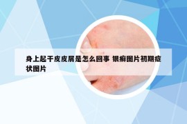 身上起干皮皮屑是怎么回事 銀癬圖片初期癥狀圖片