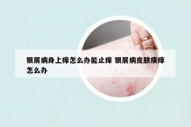 銀屑病身上癢怎么辦能止癢 銀屑病皮膚瘙癢怎么辦