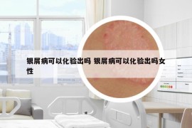 銀屑病可以化驗(yàn)出嗎 銀屑病可以化驗(yàn)出嗎女性