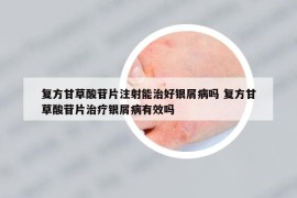 復(fù)方甘草酸苷片注射能治好銀屑病嗎 復(fù)方甘草酸苷片治療銀屑病有效嗎