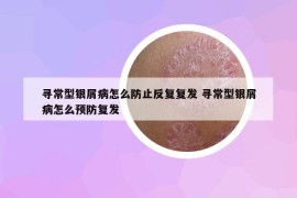 尋常型銀屑病怎么防止反復(fù)復(fù)發(fā) 尋常型銀屑病怎么預(yù)防復(fù)發(fā)