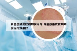 真菌感染皮膚病如何治療 真菌感染皮膚病如何治療效果好