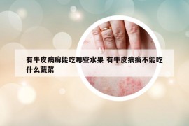 有牛皮病癬能吃哪些水果 有牛皮病癬不能吃什么蔬菜