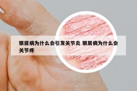 銀屑病為什么會引發(fā)關(guān)節(jié)炎 銀屑病為什么會關(guān)節(jié)疼