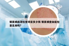 銀屑病血液檢查項目多少錢 銀屑病查血能檢查出來嗎?