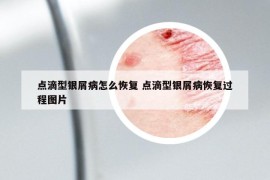 點(diǎn)滴型銀屑病怎么恢復(fù) 點(diǎn)滴型銀屑病恢復(fù)過(guò)程圖片