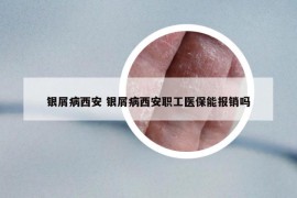 銀屑病西安 銀屑病西安職工醫(yī)保能報銷嗎