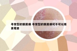 尋常型的銀屑病 尋常型的銀屑病可不可以用青霉素