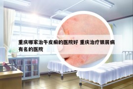 重慶哪家治牛皮癬的醫(yī)院好 重慶治療銀屑病有名的醫(yī)院