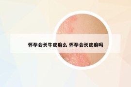 懷孕會長牛皮癬么 懷孕會長皮癬嗎
