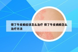 得了牛皮癬應(yīng)該怎么治療 得了牛皮病癬怎么治療方法