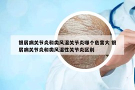 銀屑病關(guān)節(jié)炎和類(lèi)風(fēng)濕關(guān)節(jié)炎哪個(gè)危害大 銀屑病關(guān)節(jié)炎和類(lèi)風(fēng)濕性關(guān)節(jié)炎區(qū)別