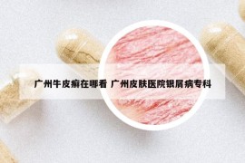 廣州牛皮癬在哪看 廣州皮膚醫(yī)院銀屑病?？? /></a>		
		</figure>

		<header class=