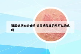 銀屑病早治能好嗎 銀屑病發(fā)現(xiàn)的早可以治愈嗎