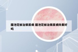 醋泡花椒治銀屑病 醋泡花椒治銀屑病效果好嗎