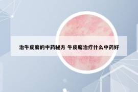 治牛皮廨的中藥秘方 牛皮廨治療什么中藥好
