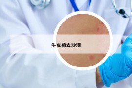 牛皮癬去沙漠