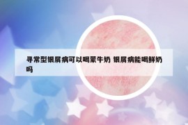 尋常型銀屑病可以喝蒙牛奶 銀屑病能喝鮮奶嗎