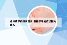 各種疹子的癥狀圖片 各種疹子的癥狀圖片 成人