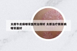 太原牛皮癬哪家醫(yī)院治得好 太原治療銀屑病哪家最好