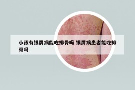 小孩有銀屑病能吃排骨嗎 銀屑病患者能吃排骨嗎