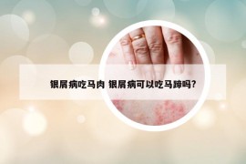 銀屑病吃馬肉 銀屑病可以吃馬蹄嗎?