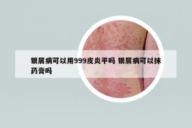 銀屑病可以用999皮炎平嗎 銀屑病可以抹藥膏嗎