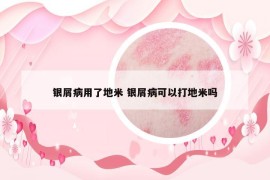 銀屑病用了地米 銀屑病可以打地米嗎