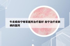 牛皮癬南寧哪家醫(yī)院治療最好 南寧治療皮膚病的醫(yī)院