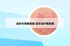 諾華針劑銀屑病 諾華治療銀屑病