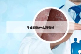 牛皮蘚涂什么藥膏好