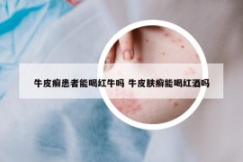 牛皮癬患者能喝紅牛嗎 牛皮膚癬能喝紅酒嗎
