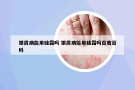 銀屑病能用硅霜嗎 銀屑病能用硅霜嗎百度百科