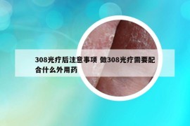 308光療后注意事項(xiàng) 做308光療需要配合什么外用藥
