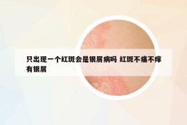 只出現(xiàn)一個(gè)紅斑會(huì)是銀屑病嗎 紅斑不痛不癢有銀屑