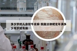 多少歲的人會(huì)犯牛皮癬 我國(guó)法律規(guī)定年滿(mǎn)多少周歲就有癬