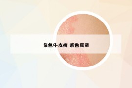 紫色牛皮癬 紫色真蘚
