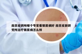 南京皮研所哪個(gè)專家看銀屑病好 南京皮膚研究所治療銀屑病怎么樣