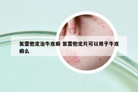 氯雷他定治牛皮癬 氯雷他定片可以用于牛皮癬么