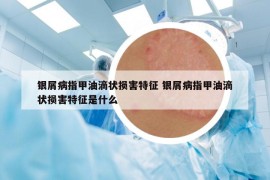 銀屑病指甲油滴狀損害特征 銀屑病指甲油滴狀損害特征是什么