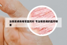 治銀屑病有哪家醫(yī)院好 專治銀屑病的醫(yī)院哪里