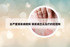 去嚴(yán)重銀屑病視頻 銀屑病怎么治療的短視頻