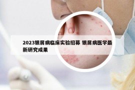 2023銀屑病臨床實(shí)驗(yàn)招募 銀屑病醫(yī)學(xué)最新研究成果