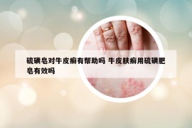 硫磺皂對牛皮癬有幫助嗎 牛皮膚癬用硫磺肥皂有效嗎