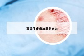 夏季牛皮癬加重怎么辦