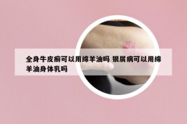 全身牛皮癬可以用綿羊油嗎 銀屑病可以用綿羊油身體乳嗎