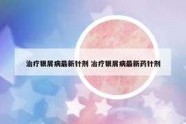 治療銀屑病最新針劑 冶療銀屑病最新藥針劑