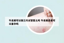 牛皮癬可以做三代試管嬰兒嗎 牛皮癬患者可以備孕嗎