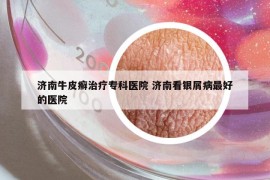濟(jì)南牛皮癬治療?？漆t(yī)院 濟(jì)南看銀屑病最好的醫(yī)院