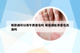 銀屑病可以用牛黃香皂嗎 銀屑病能用香皂洗澡嗎